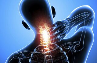 Cervikální osteochondróza