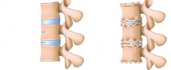 zdravá páteř a osteochondróza