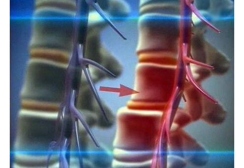 Mačkání nervových zakončení u bederní osteochondrózy