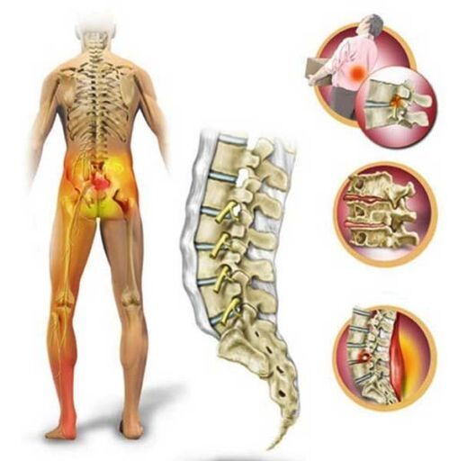 Osteochondróza bederní páteře, způsobující bolesti zad