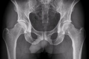 Diagnostické možnosti pro artrózu kyčelního kloubu