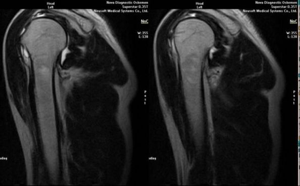 rentgen k diagnostice artrózy ramene