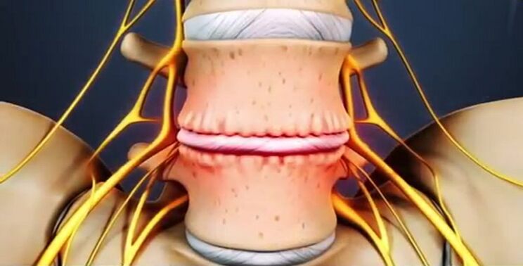 léze páteře v důsledku osteochondrózy